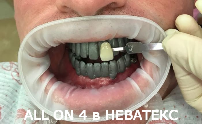 Система протезирование All on 6 all on 6